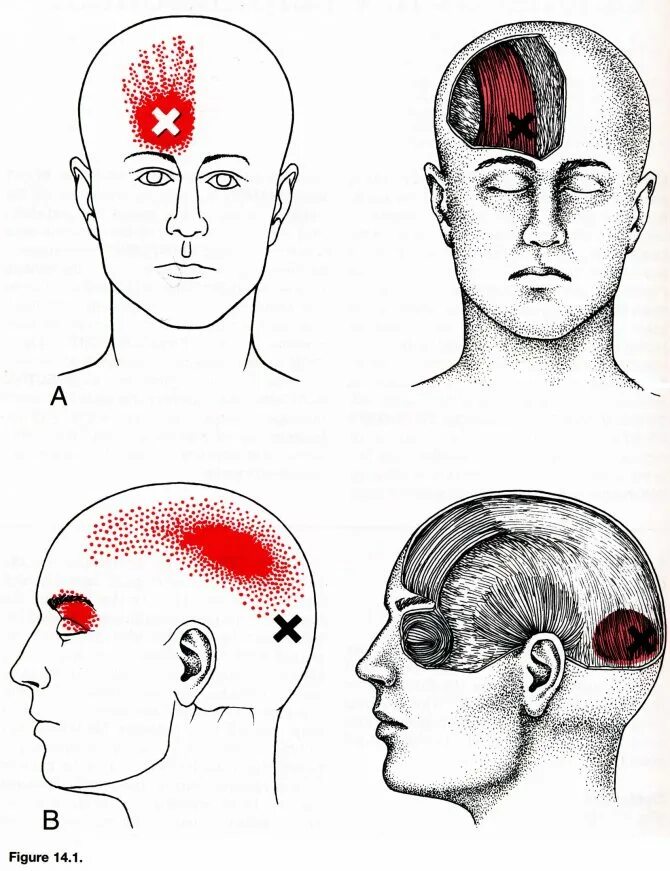Болит лоб форум. Области головной боли. Локализация головной боли и причины. Причины головной боли. Головная боль в затылке.