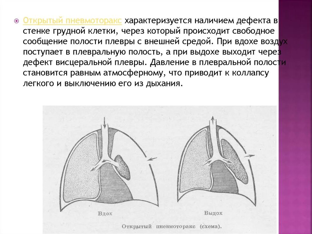 Воздух в легкие поступает через. Парамедиастинальный пневмоторакс. Форма грудной клетки при пневмотораксе. Коллапсотерапия искусственный пневмоторакс. Пристеночный пневмоторакс.