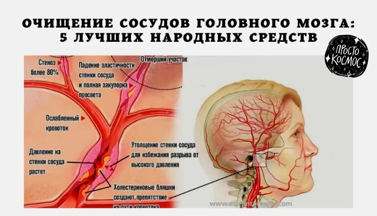 Как вылечить сосуды головного. Как очистить сосуды головного мозга. очищение сосудов головного мозга. средство для очищения сосудов головного мозга.