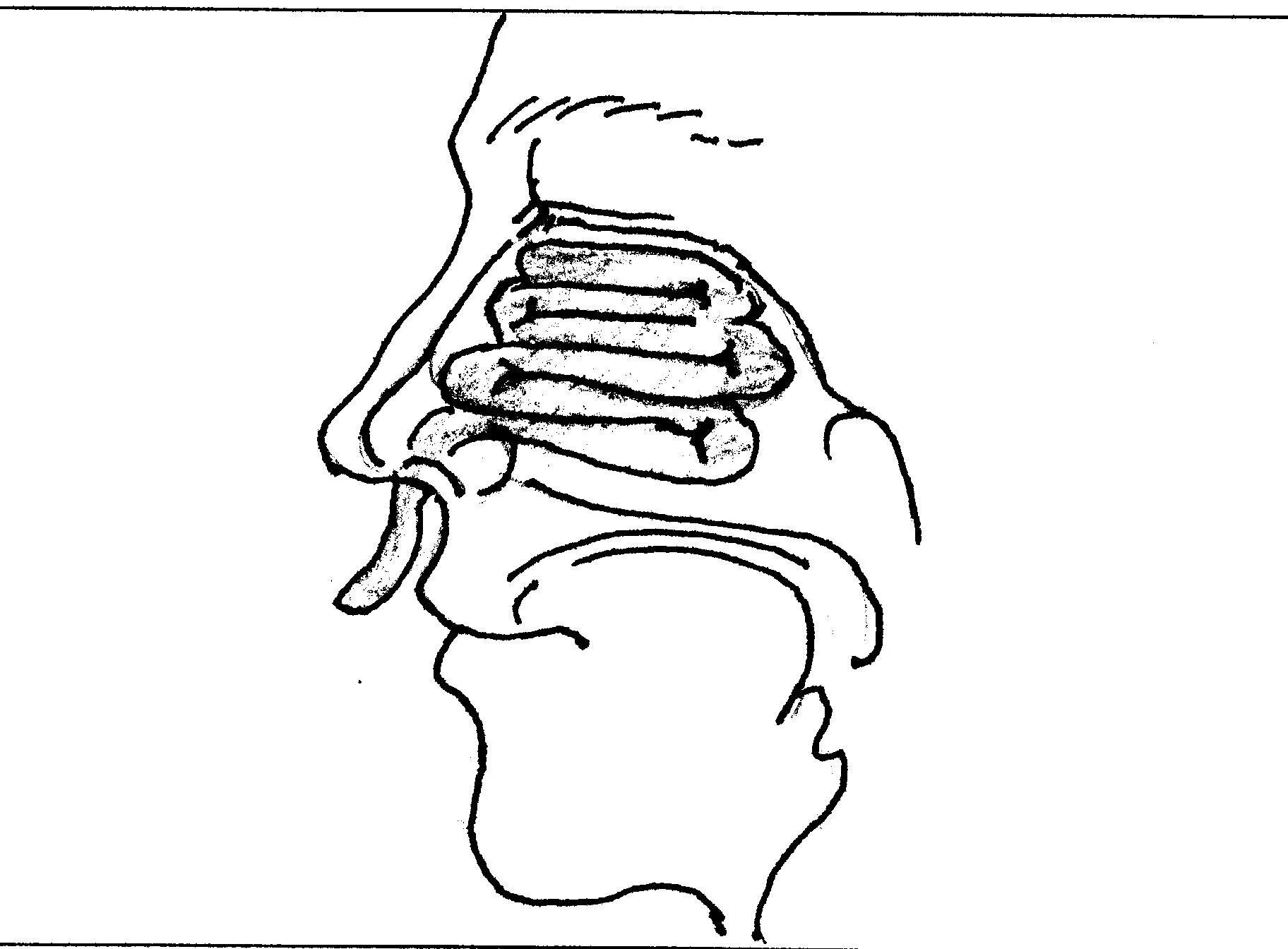 Передняя тампонада носа алгоритм. Задняя тампонада носа алгоритм. Передняя тампонада носовых ходов. Передняя тампонада носа при носовом кровотечении.