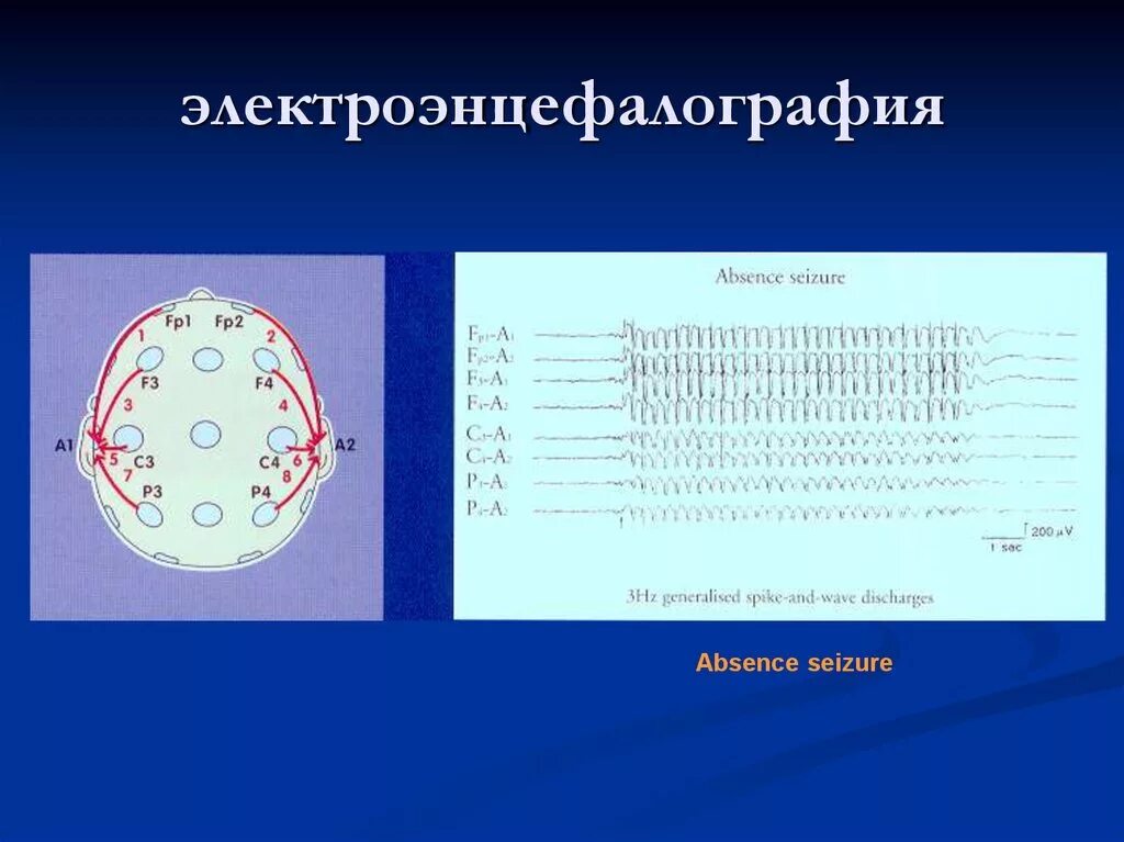 Метод электроэнцефалографии позволяет определить