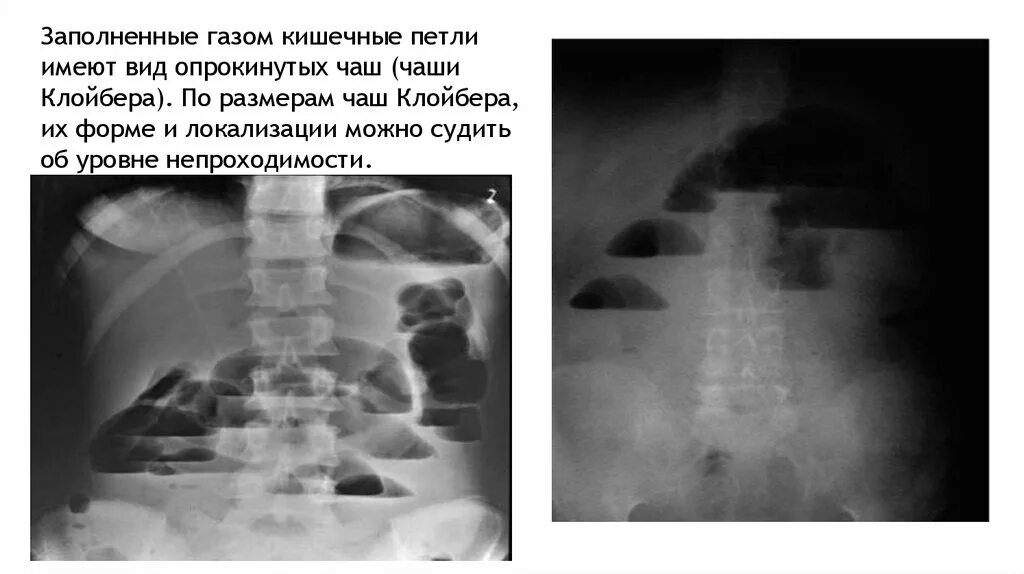 Уровень на рентгене. Кишечная непроходимость чаши клойбера. рентген брюшной полости чаши клойбера. кишечная непроходимость рентген чаши клойбера. при кишечной непроходимости на рентгене чаши.