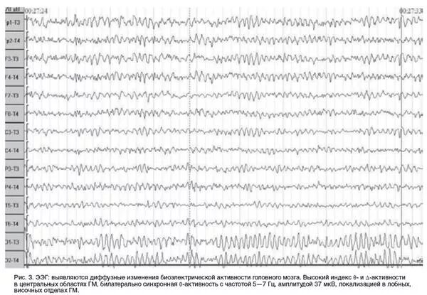 ЭЭГ диффузные изменения биоэлектрической активности головного мозга. Умеренные изменения биоэлектрической активности головного мозга. Выраженные диффузные изменения БЭА головного мозга. ЭЭГ легкие диффузные изменения. Умеренная дезорганизация биоэлектрической активности мозга