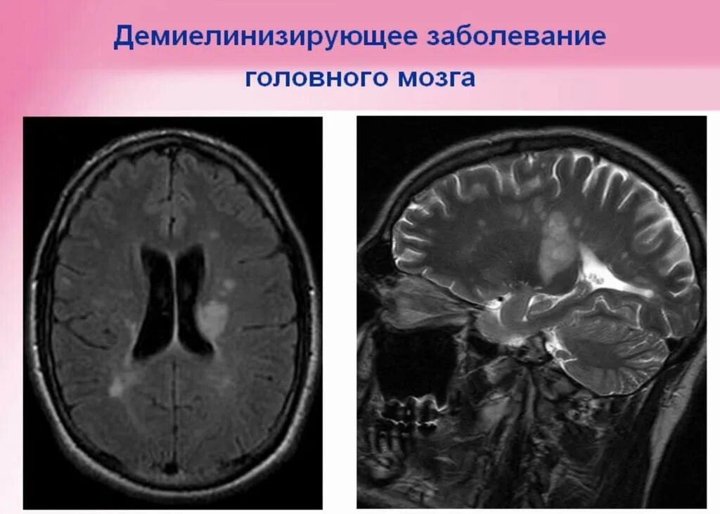 Демиелинизирующие заболевания нервной системы мрт. Демиелинизирующие заболевания головного мозга на мрт. Демиелинизирующий процесс головного мозга на мрт. Очаги демиелинизации головного мозга на мрт. Признаки демиелинизирующего поражения