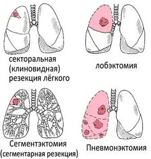 Сколько времени длится операция легких