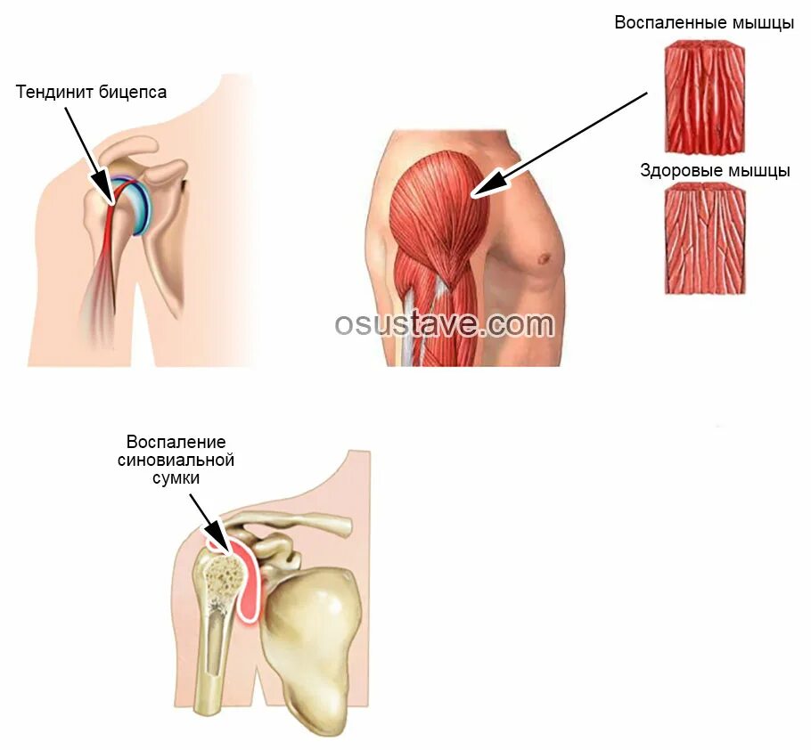 Почему болит сустав плеча. Бои в плечевом суставе. Боли в плечевом суставе плече.