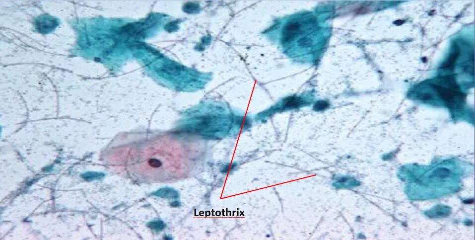 Лептотрикс лечение. Лептотрикс микроскопия. Лептотрикс под микроскопом. Микроскоп лептотрикс. Грибы кандида лептотрикс.