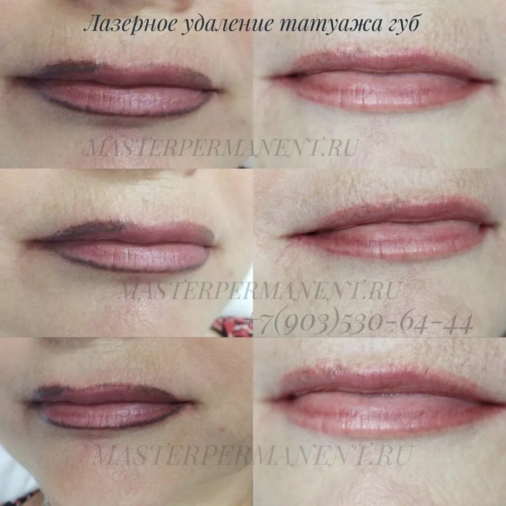 Губы после удаления лазером. Губы после удаления лазером. Губы после удаления лазером. Татуаж губ фото до и после. Перманентный макияж губ.