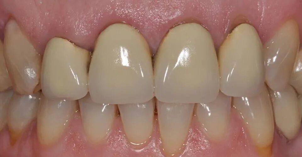 диоксид циркония коронки. металлокерамическая коронка а1. металлопластиковые коронки на зубы. металлопластмассовые коронки. металлопластиковые коронки.