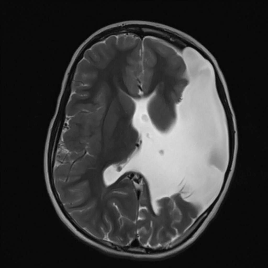 Киста мозга рассосалась. Порэнцефалическая киста головного мозга кт. Шизэнцефалия мрт. Закрытая шизэнцефалия головного мозга мрт.
