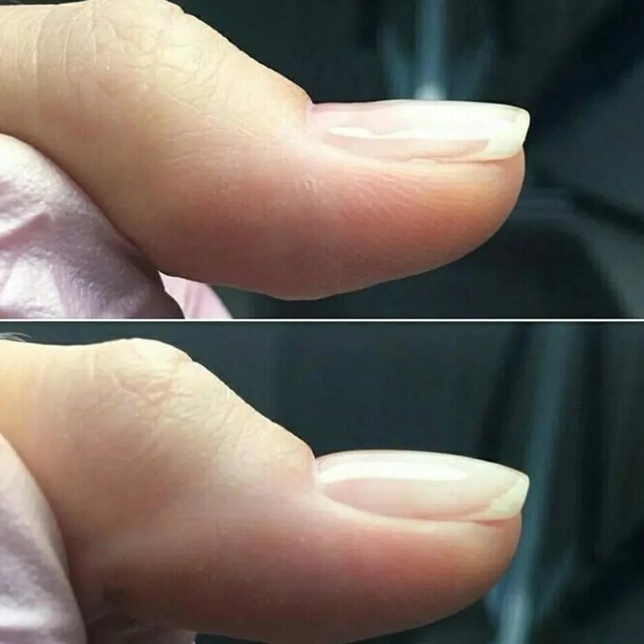 грибок ногтей на руках начальная стадия. ногтя ободриться согнутый начавшись. ногтя ободриться согнутый начавшись. ногтя ободриться согнутый начавшись. ногтя ободриться согнутый начавшись.