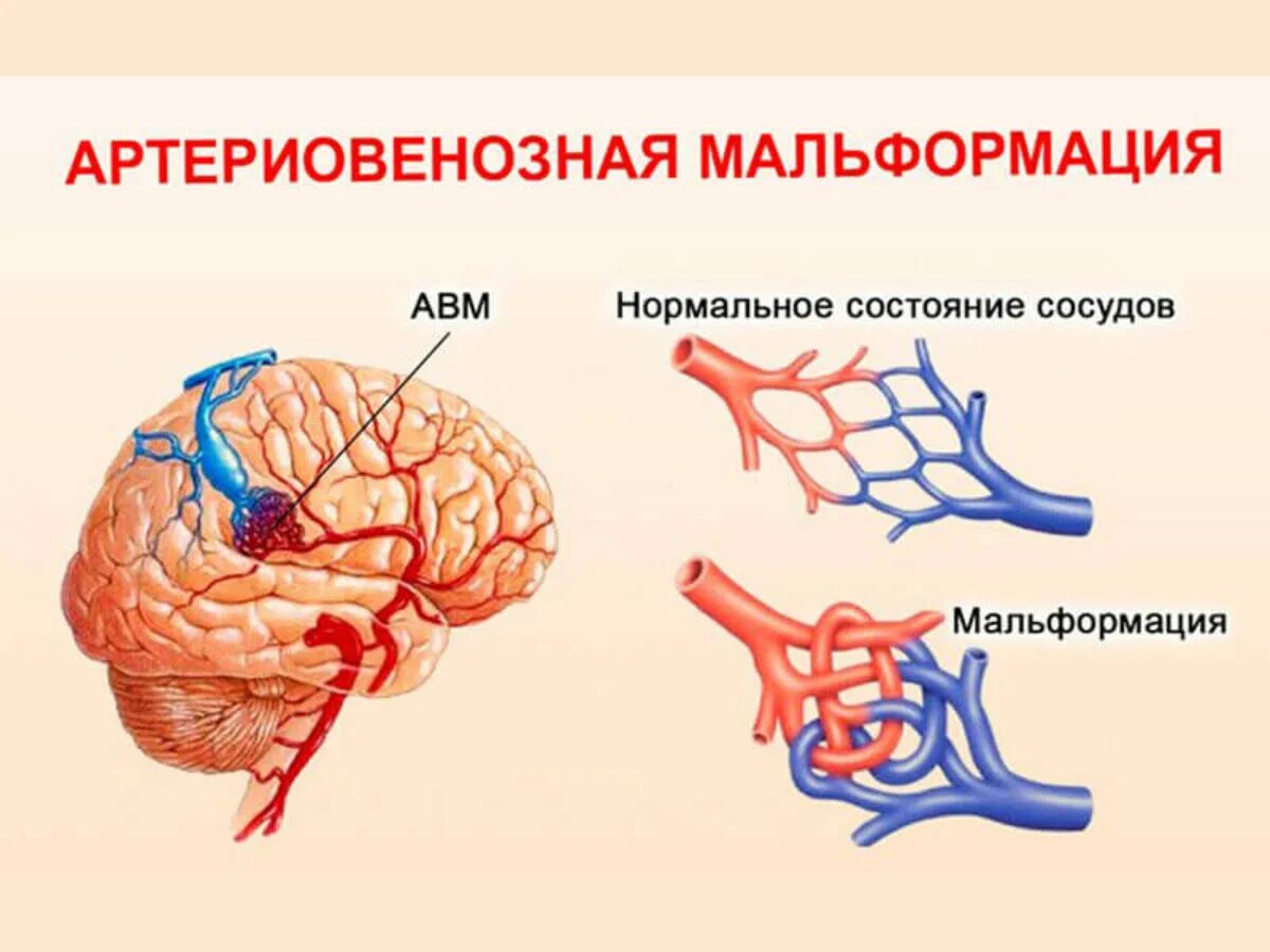 Мальформация сосудов. Артериально венозная мальформация. артериовенозная мальформация сосудов. мальформация сосудов головного мозга. артериовенозные мальформации сосудов головного мозга.