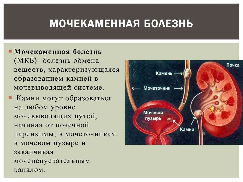 Заболевания мочевыделительной системы мочекаменная болезнь. Мочекаменная болезнь (уролитиаз). Мочекаменная болезнь урология камни мочеточника. Система мочевыделения при мочекаменной болезни. Боли в области мочеточника