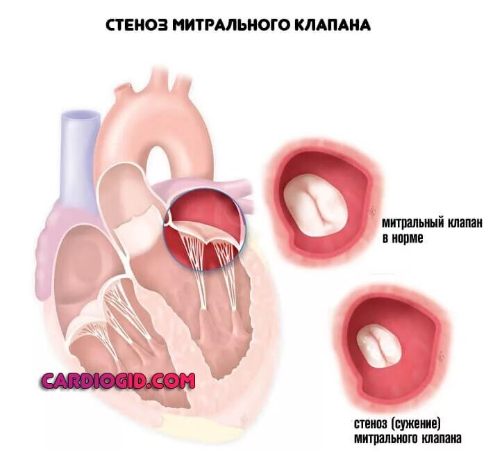 Поражение митрального клапана. Митральные пороки сердца (стеноз, недостаточность. Стеноз митрального клапана сердца. Дисплазия митрального клапана сердца что это такое. Порок митрального клапана сердца.