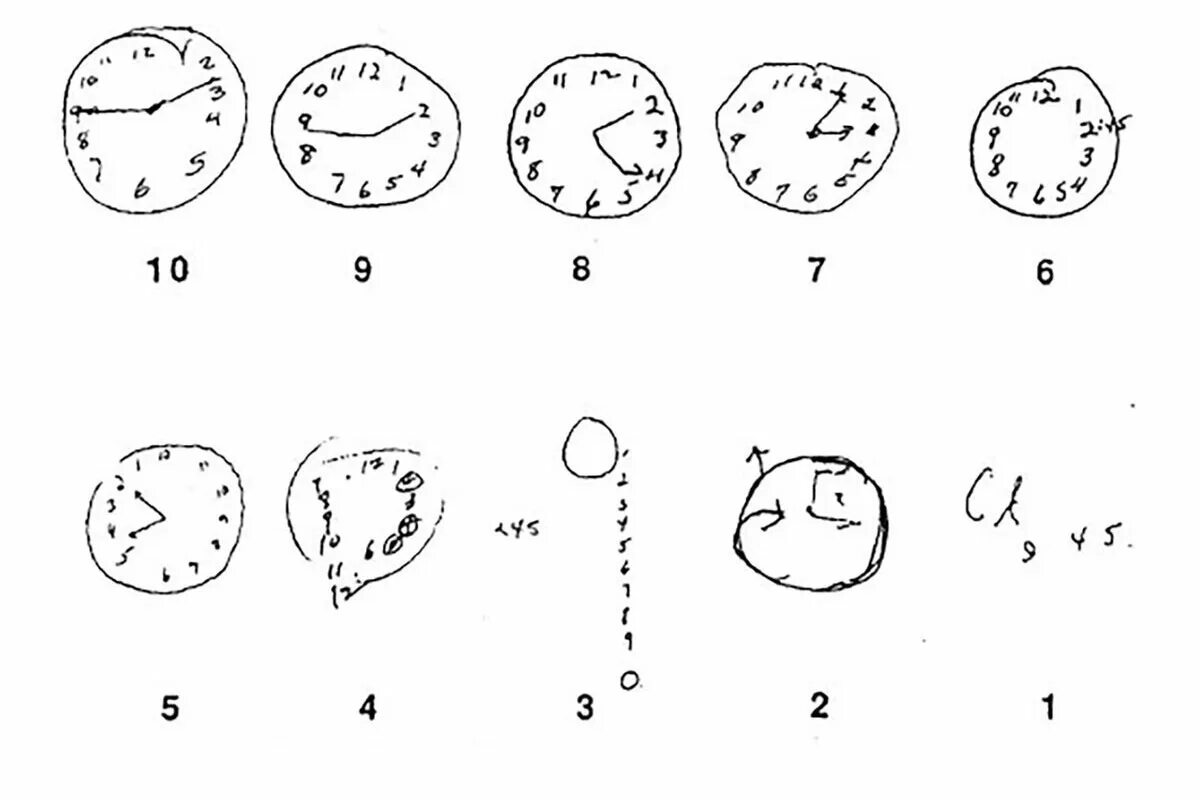 Тест рисования часов при болезни Альцгеймера. Тест с циферблатом на болезнь Альцгеймера. Тест рисования часов при деменции. Тесты для определения деменции и Альцгеймера.