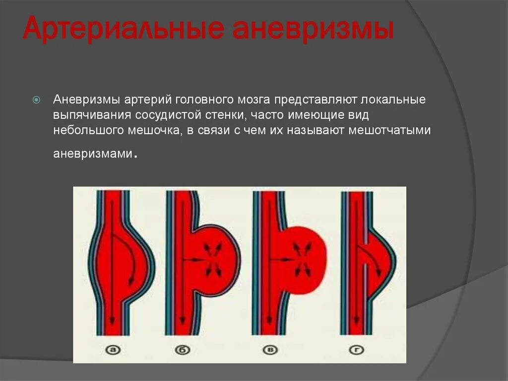 Как распознать аневризму
