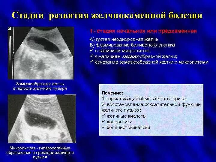 Желчный пузырь гомогенное что значит