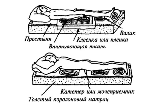 Чем обрабатывать пролежни у лежачих