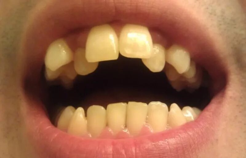 Два зуба кривые. Два зуба кривые. Исправление зубов винирами. Короткие ровные зубы. Два передних зуба кривые.