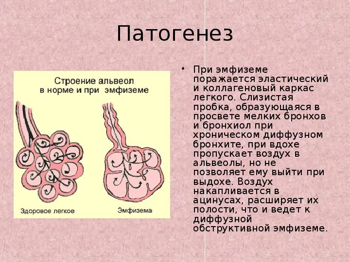 Патогенез эмфиземы легких. Патогенез при эмфиземе. Механизм развития эмфиземы легких. Эмфизема этиология. Альвеолярные легкие характерны для