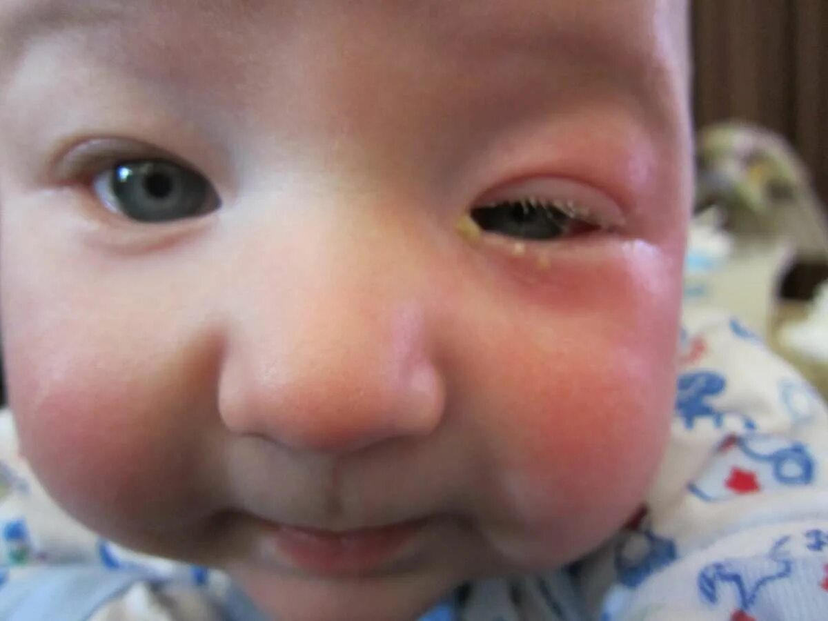 Почему у новорожденного глазки. Флегмонозный острый дакриоцистит. Врожденный дакриоцистит. Дакриоцистит у грудничка.