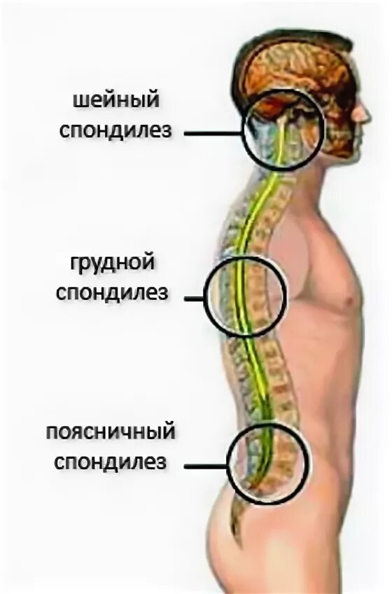 Грудной спондилез лечение симптомы. Спондилез крестцового отдела. Спондилез с3-с7 позвонков. Спондилёз грудного отдела позвоночника что это такое. Шейный спондилез.