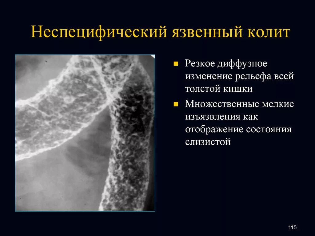 Клинические проявления язвенного колита. Некротизирующий язвенный колит. Рентгенологические признаки язвенного колита. Неравномерная диффузная