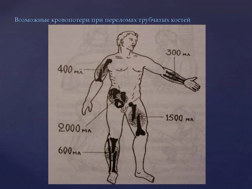 Кровопотери при переломах. Кровопотеря при переломах. кровопотеря при переломах костей. кровопотеря при переломе кости. кровотечение из трубчатых костей перелом фото.