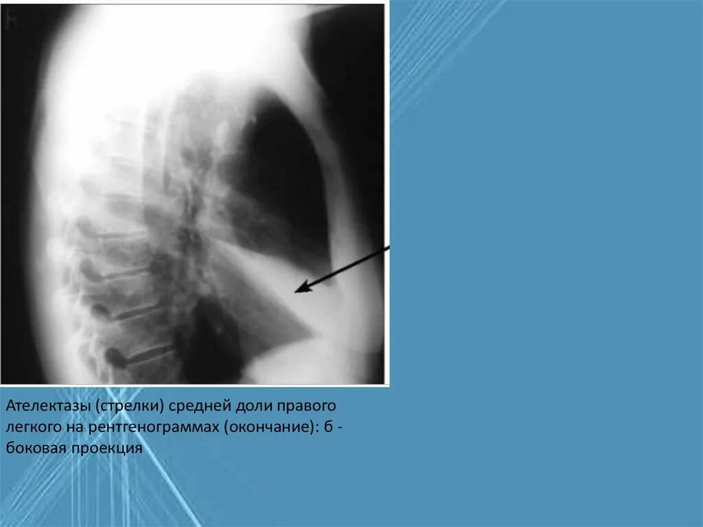 Ателектаз левой доли легкого. Ателектаз средней доли правого легкого рентгенограмма. Ателектаз сегментарный на рентгенограмме. Дисковидный ателектаз рентген. Ателектаз верхней доли правого легкого рентгенограмма.