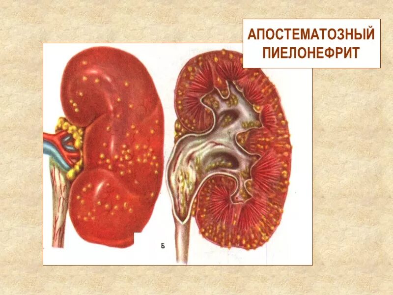 Воспаление почек заболевание. Острый нефрит пиелонефрит. Пиелонефрит Гнойный апостематозный. Пиелонефрит почек макропрепарат. Острый Гнойный апостематозный пиелонефрит.
