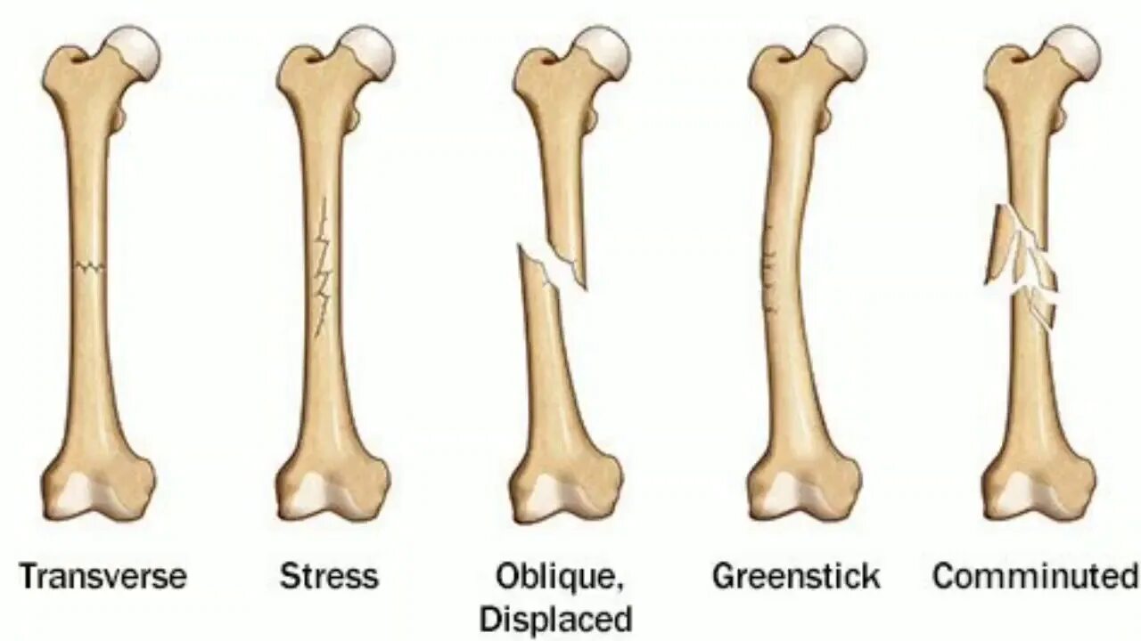 Типы переломов трубчатых костей. Переломы трубчатых костей.