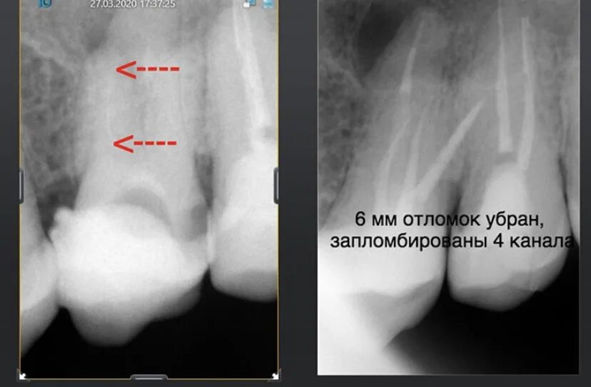 Запломбированный канал в зубе снимок. Запломбированный канал на снимке. Запломбированные каналы зуба на рентгене. Как выглядит запломбированный канал.