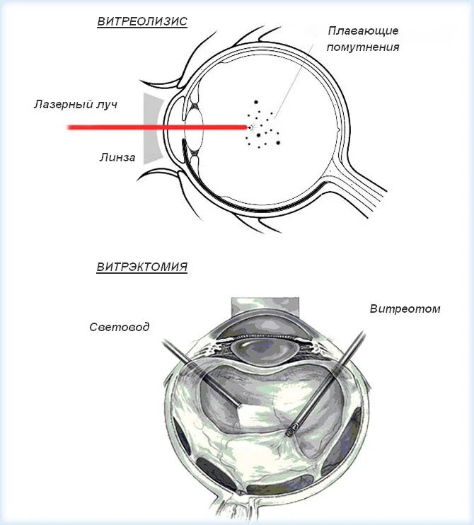 Витреолизис цена. Фибриллы стекловидного тела. Помутнение хрусталика и стекловидного тела. Деструктуризация стекловидного тела. Витреолизис стекловидного тела.