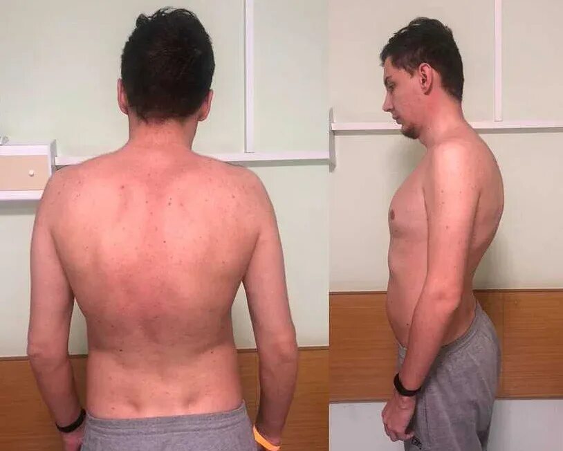 Кифоз позвоночника это горб. Кифосколиоз шейного отдела позвоночника. Искривление осанки кифоза. Кифоз. Климактерический горб.