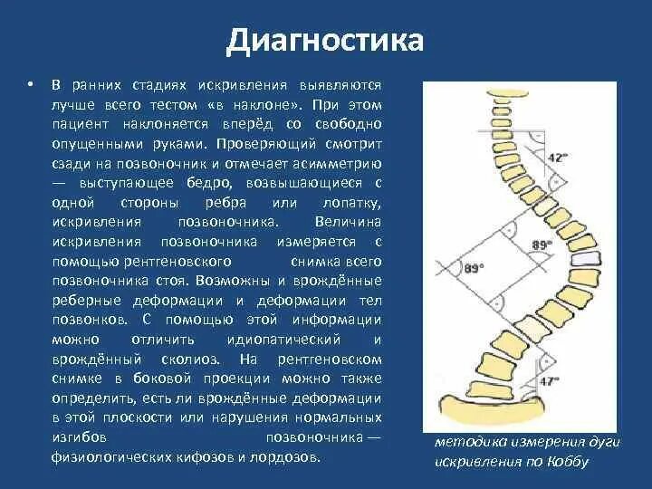 Измерение угла сколиоза по чаклину. Степени сколиоза позвоночника по коббу. Метод Кобба сколиоз позвоночника. Угол Кобба степени сколиоза. Угол кобба