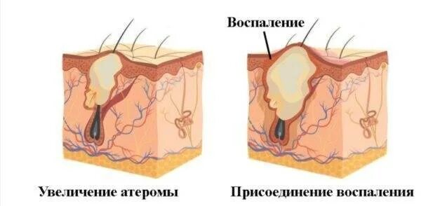 Капсула жировика. Атерома воспаление сальной железы. Кисты / атеромы сальных желез. Эпидермальная сальная киста.