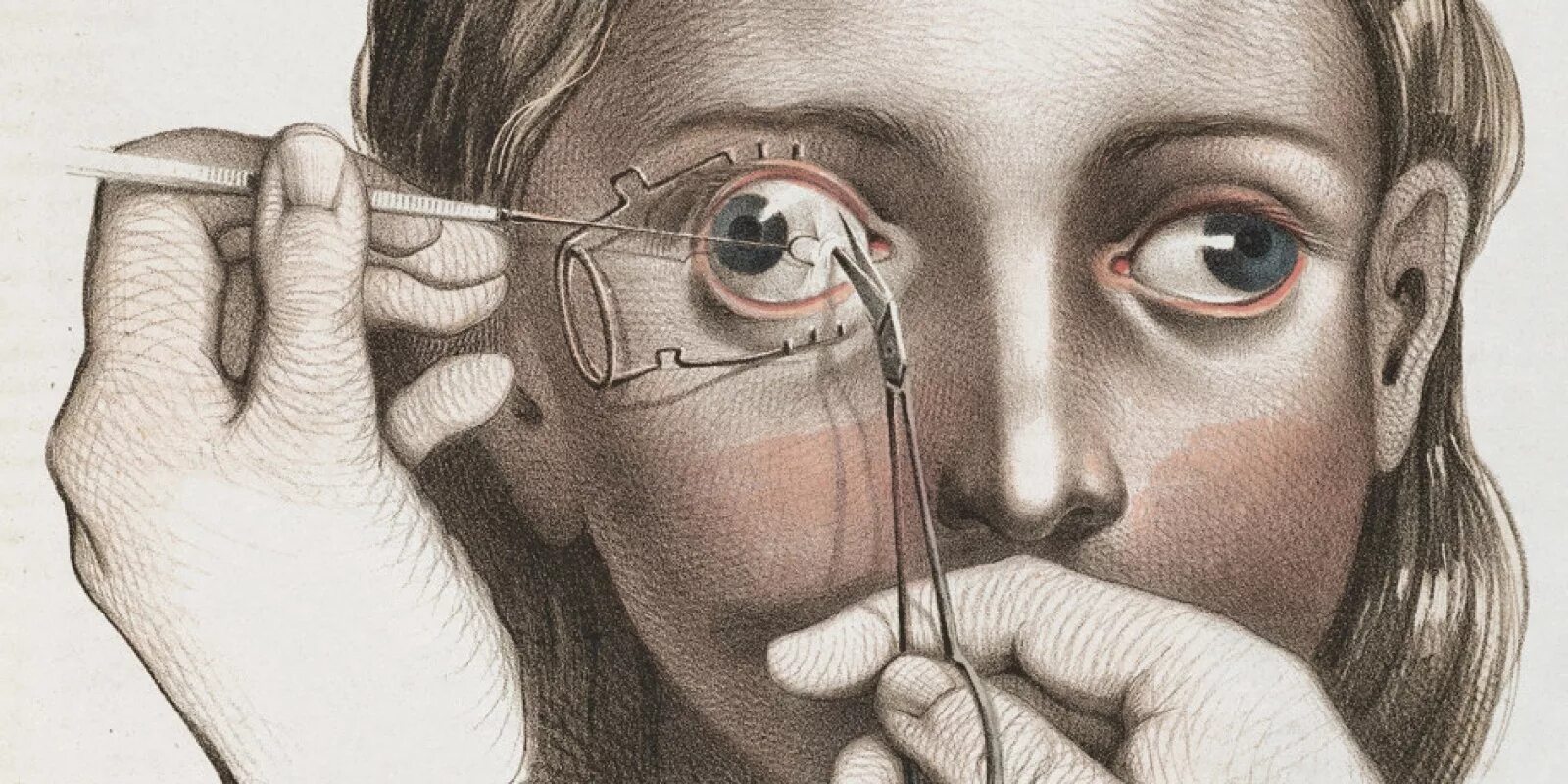 Больно шевелить глазами. Операции на глазах в древности. Хирургия глаз в средние века. Офтальмология в искусстве. Глазная хирургия в средние века-.