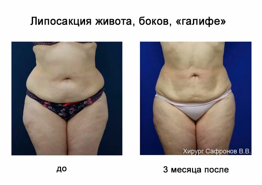 Уплотнения после липосакции