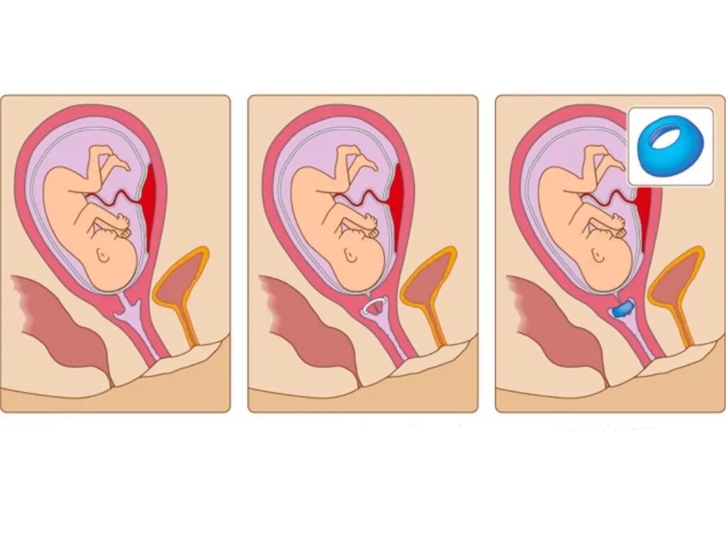 Истмико-цервикальная недостаточность — короткая шейка матки. Акушерский пессарий при ИЦН. Кольцо на шейку матки при беременности. Матка на 35 неделе беременности