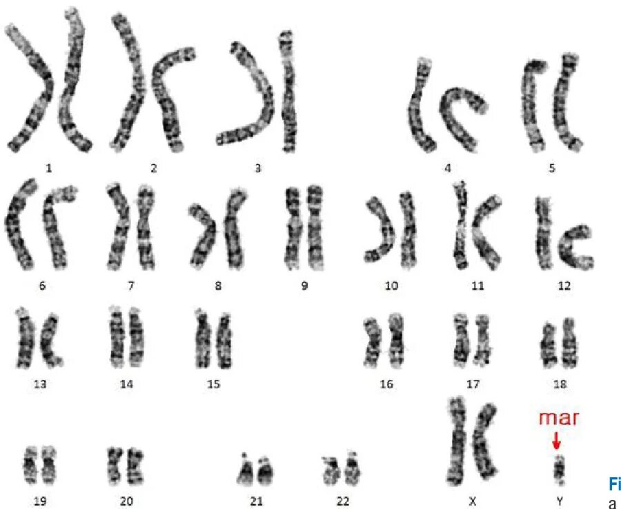 Строение хромосом человека. Набор хромосом при синдроме Дауна. Субметацентрические хромосомы рисунок. Политенные хромосомы дрозофилы. Удвоение набора хромосом