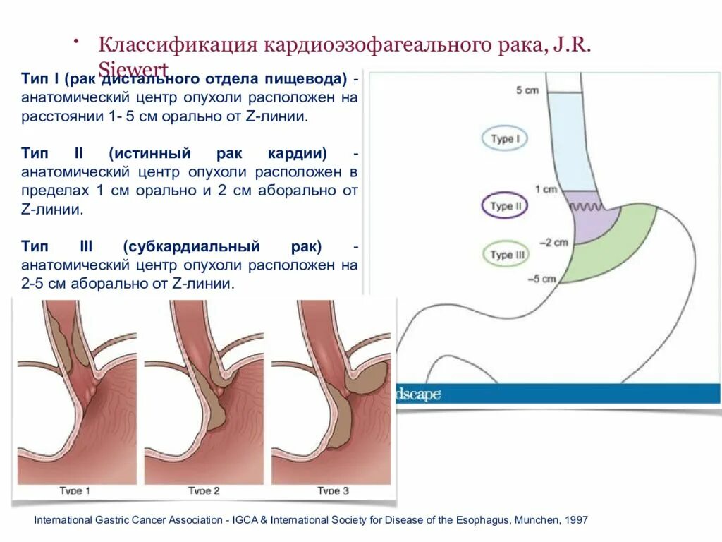 Классификация опухоли пищеводно желудочного перехода. Классификация опухолей кардиоэзофагеального перехода по Siewert. Классификация Зиверт. Эзофагокардиальный отдел пищевода. Лечения пищевода и желудка