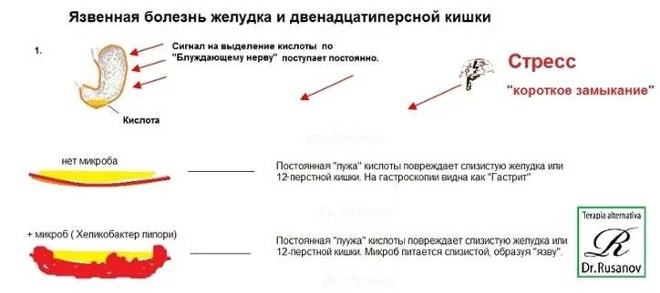 Язвенная болезнь желудка тест с ответом. Влияние стресса на язвенную болезнь. Стрессовые язвы желудка. Стрессы при язвенной болезни.