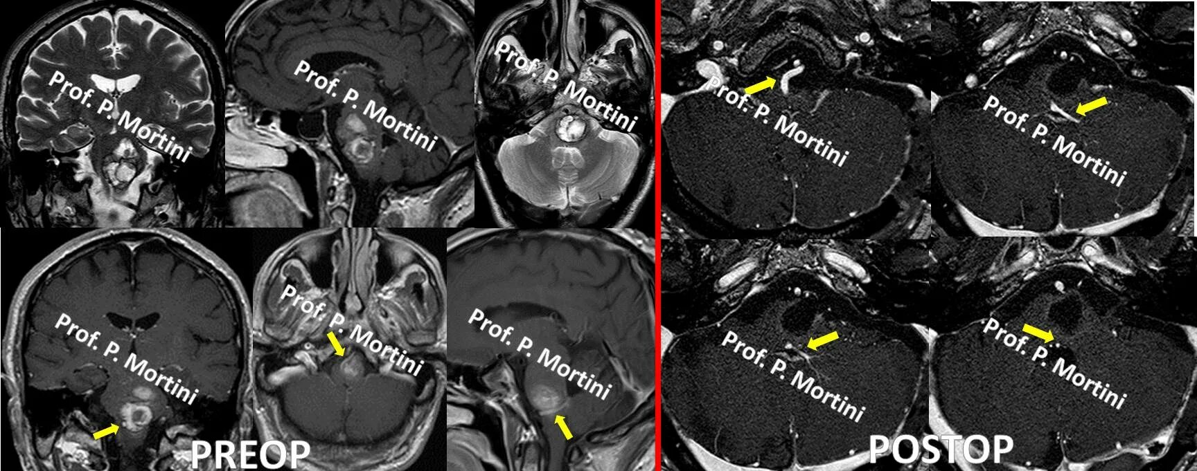 Гемангиома кавернозного синуса. Гемангиома головного мозга мрт. Телеангиэктазия ствола головного мозга мрт. Гемангиома головного мозга у взрослых прогноз. Кавернома мозжечка мрт.