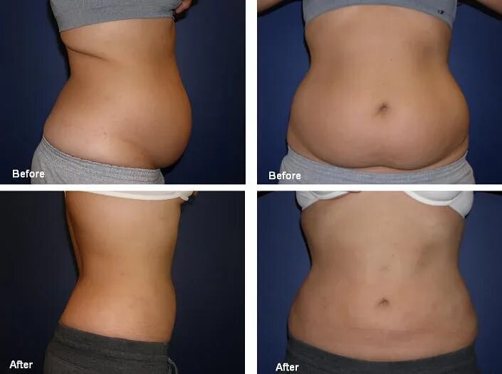 Кавитация для похудения до и после Client Results RK Centre
