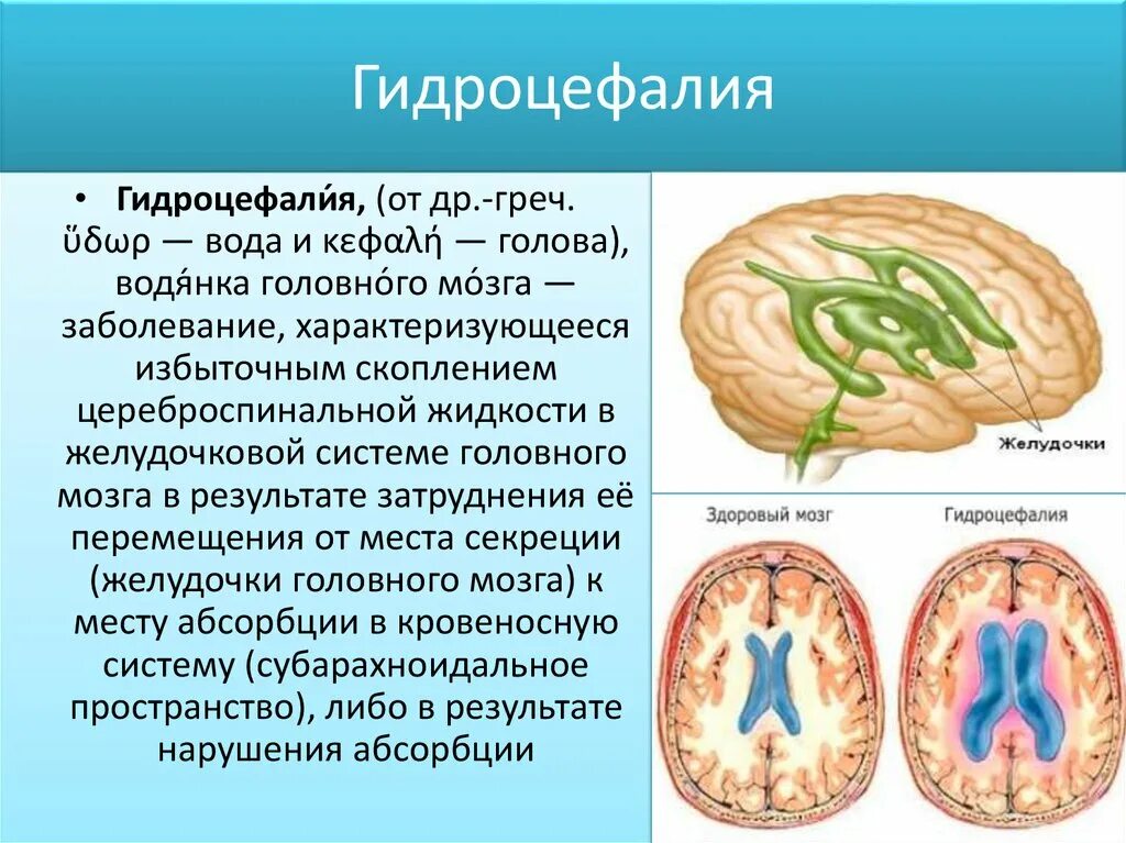 Наружная и внутренняя гидроцефалия головного мозга. Внутренняя сообщающаяся гидроцефалия. Наружная гидроцефалия головного мозга.