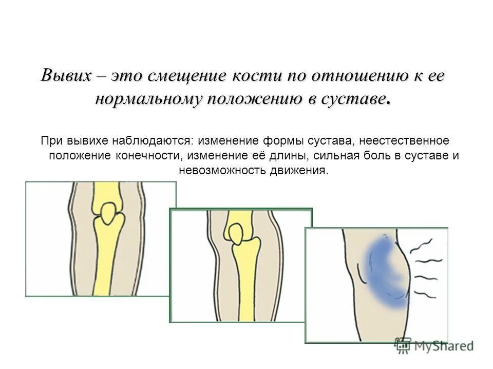Вывих сустава происходит при. Травматические и патологические вывихи. Вывих сустава происходит при. Вывих сустава происходит при. Презентация на тему вывихи.