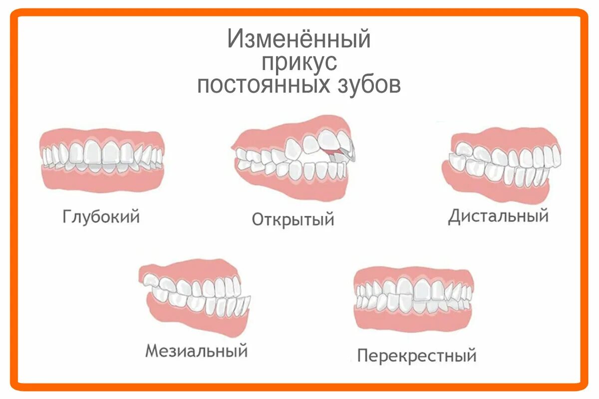 Почему меняются зубы. Глубокий прикус у человека схема. Неправильный прикус зубов. Прикус зубов правильный прикус. Прикус зубов неправильный у детей что.