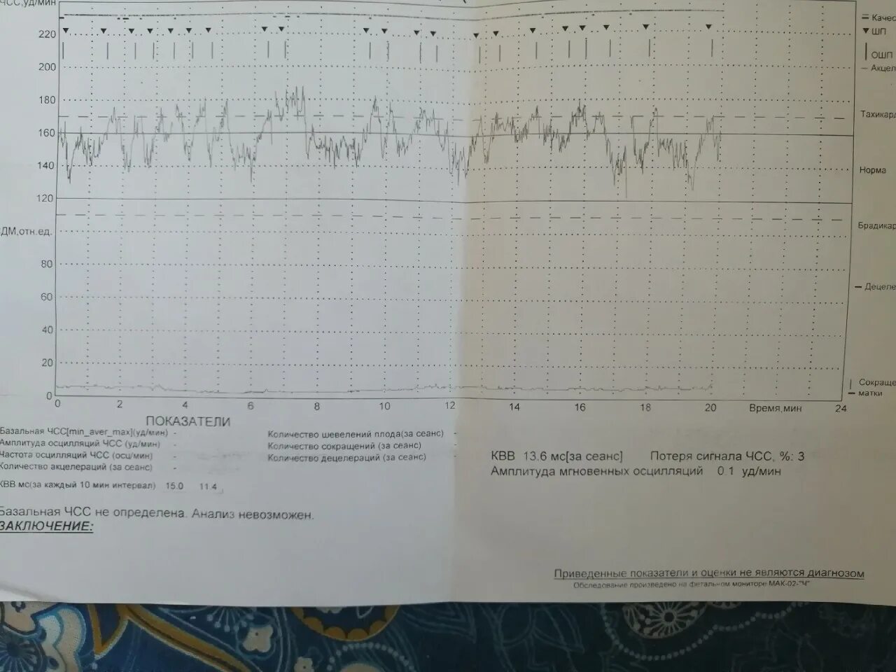 Синусовый ритм КТГ. Тахикардия на КТГ. Тахикардия плода по КТГ. Базальный ритм на КТГ. Пульс в 3 триместре