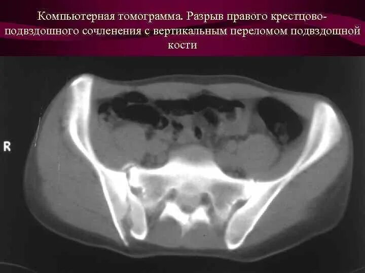 Кт подвздошной кости. Правая подвздошная кость кт. Вертикальный перелом подвздошной кости. Перелом подвздошной кости кт.