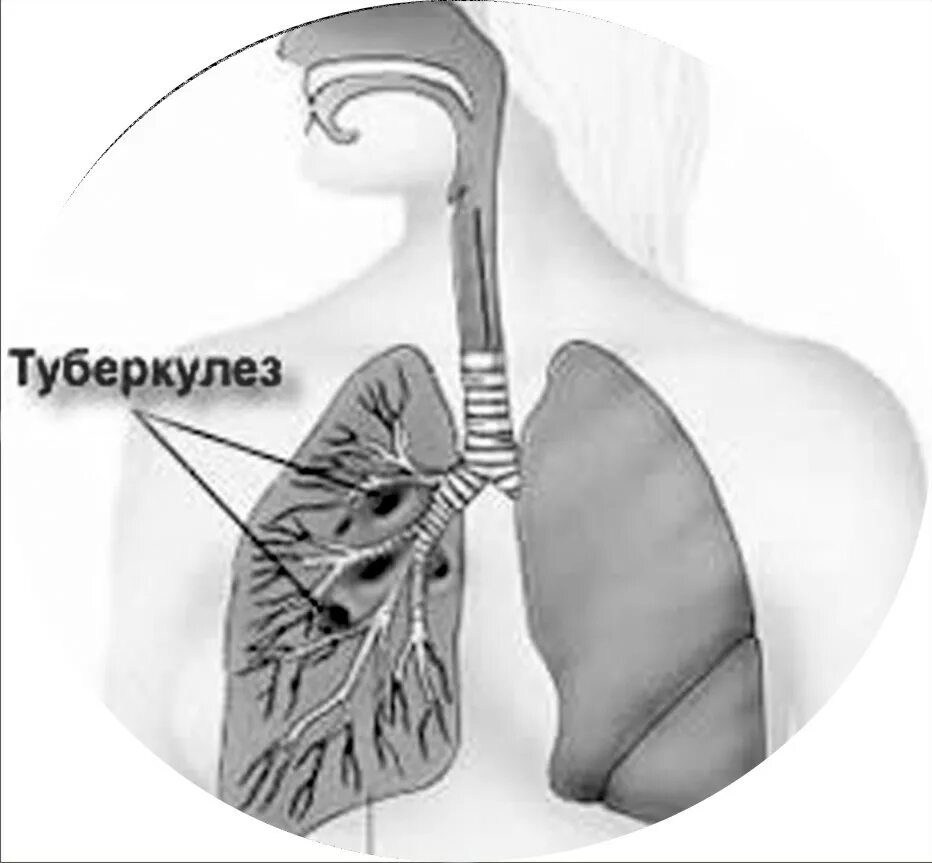 Легкие человека с туберкулезом